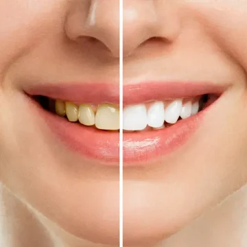 Teeth Whitening Guide: What are the Treatment Options, Procedure, Results?