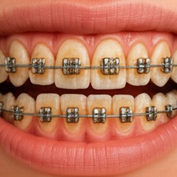 How Do You Get Rid of Braces Stains? Safe Solutions for Long-Lasting Results