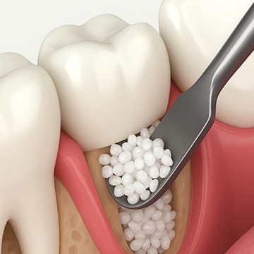 What Is a Bone Graft for Teeth? Signs You Might Be a Candidate