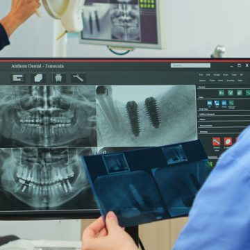 What Is a Bone Graft for Teeth? Signs You Might Be a Candidate