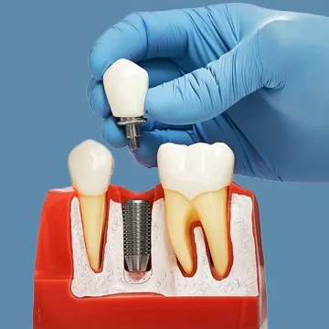 Why Do Missing Teeth Cause Bone Loss and How Do Implants Help?