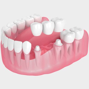 How Does a Dental Bridge Replace Missing Teeth?
