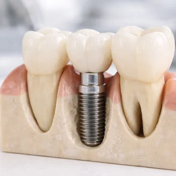 Dental Implants and Vitamin D: Does Vitamin D Affect Implant Success?